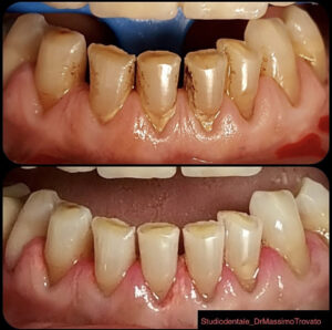 Sbiancamento professionale denti usurati e rimozione macchie con air-flow