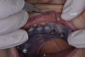 Dima chirurgica per impianti dentali