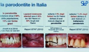 Incidenza della malattia parodontale in italia